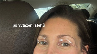 FOTO: Tereza Kerndlová podstoupila operaci víček.