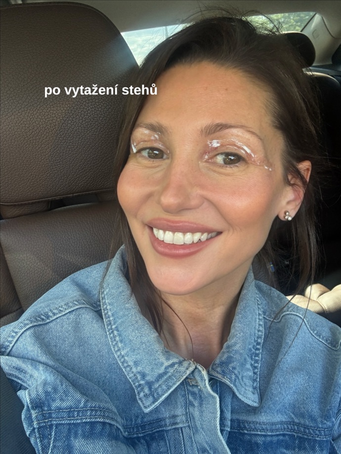 Tereza Kerndlová podstoupila operaci víček.