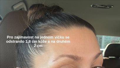 FOTO: Tereza Kerndlová po operaci.