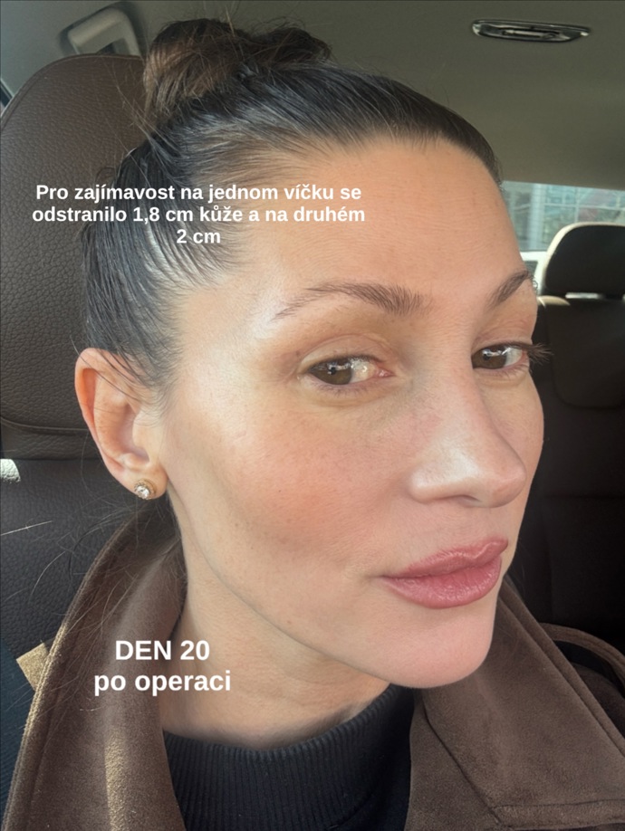 Tereza Kerndlová po operaci. 